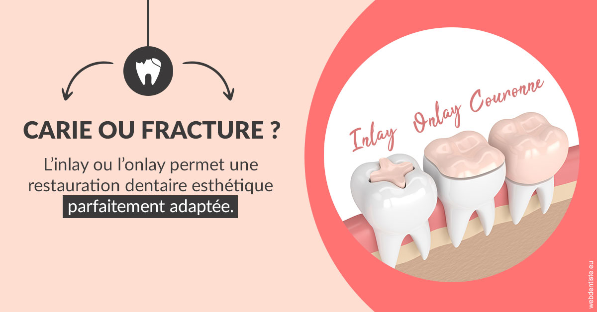 https://dr-remy-ouazana.chirurgiens-dentistes.fr/T2 2023 - Carie ou fracture 2