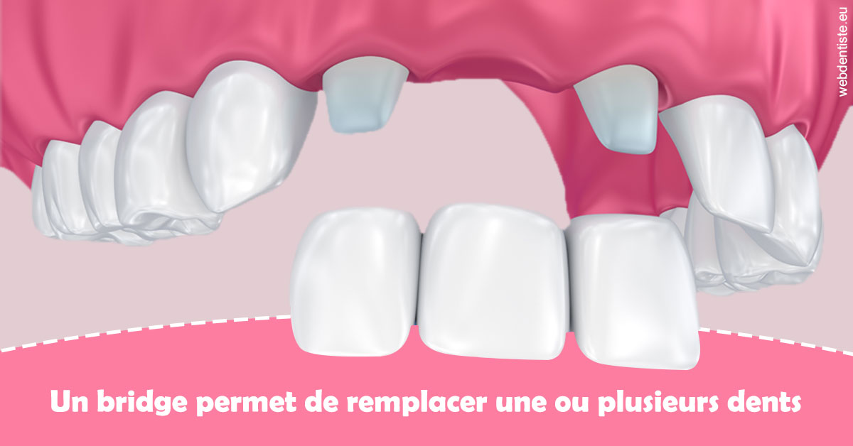 https://dr-remy-ouazana.chirurgiens-dentistes.fr/Bridge remplacer dents 2