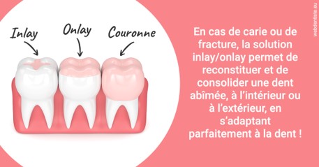 https://dr-remy-ouazana.chirurgiens-dentistes.fr/L'INLAY ou l'ONLAY 2