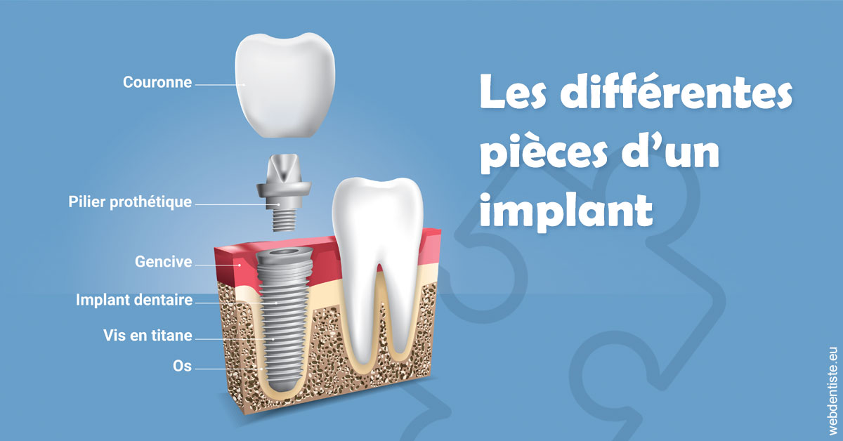 https://dr-remy-ouazana.chirurgiens-dentistes.fr/Les différentes pièces d’un implant 1